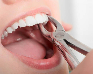 کشیدن دندان