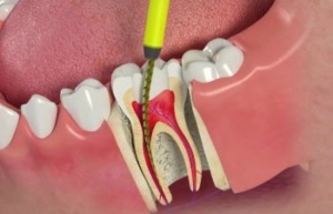 ریشه دندان
