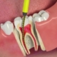 ریشه دندان