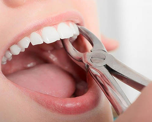 کشیدن دندان